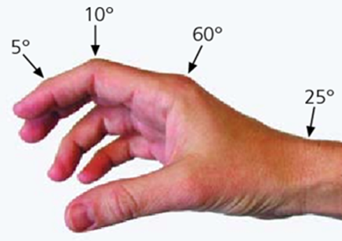 Management of Burns of Dorsum of Hand: Tangential Excision and SSG in Management of Burns of Dorsum of Hand