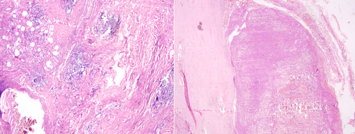  Chronic Expanding Hematoma