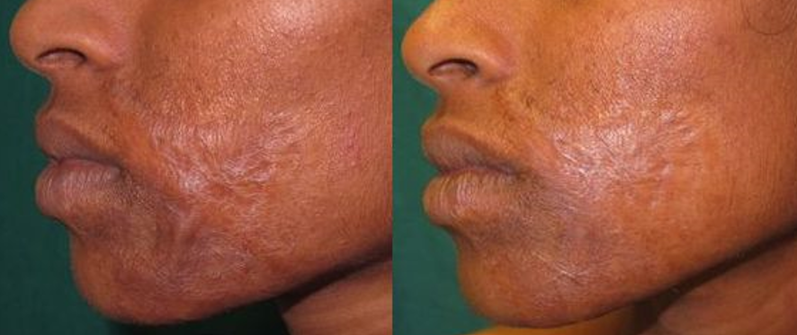 Autologous Fat Grafting on Burn Scars