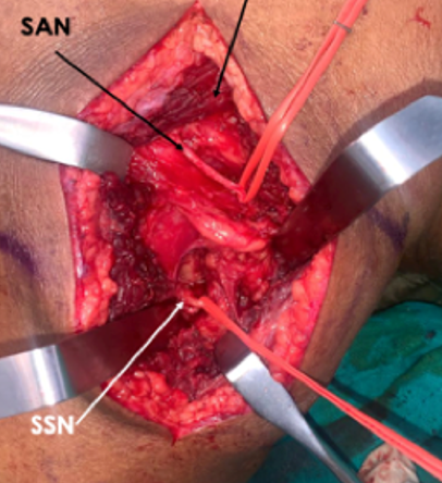 Posterior Approach for Shoulder Restoration
