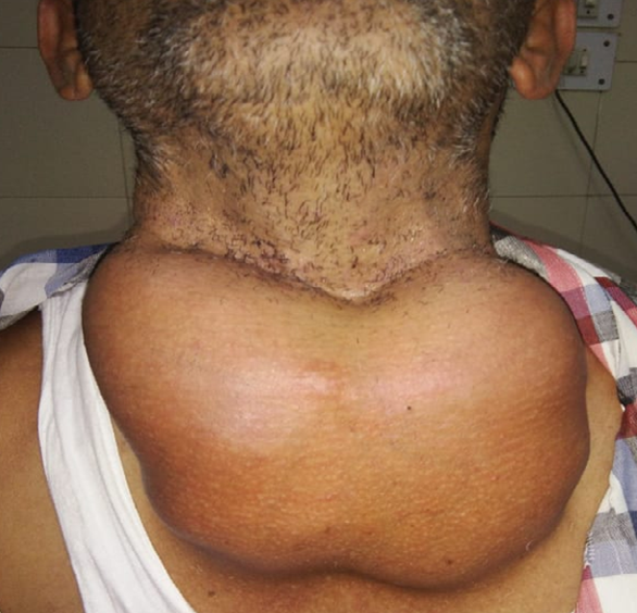 Chest Wall Reconstruction