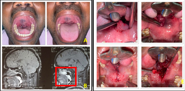 Arteriovenous Malformation over the Soft Palate