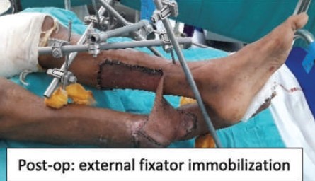 External Fixator Case report
