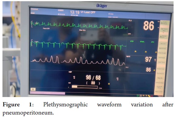 Plethysmographic waveform