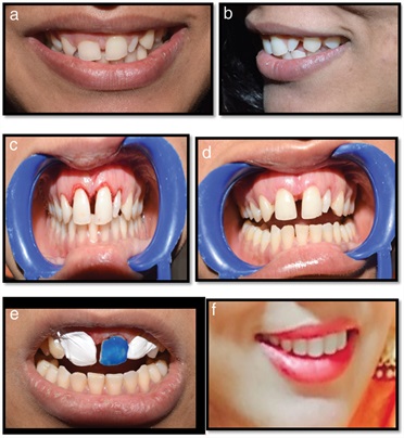Diastema