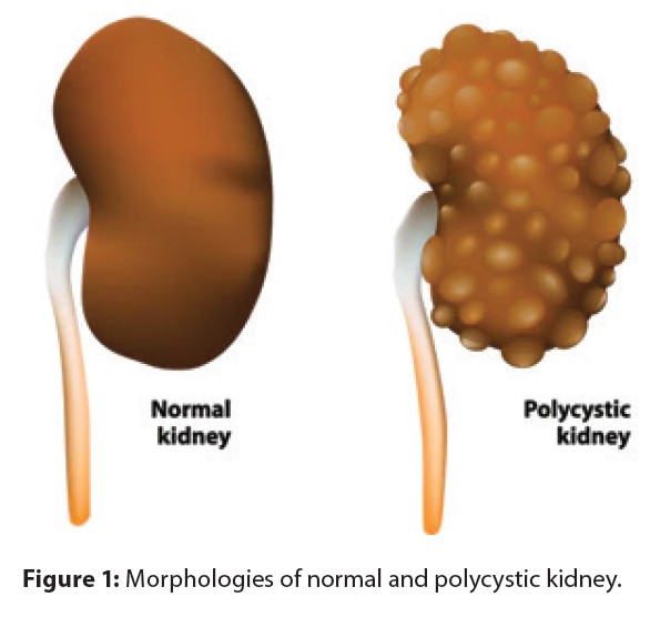 Normal Kidney vs Polycystic Kidney