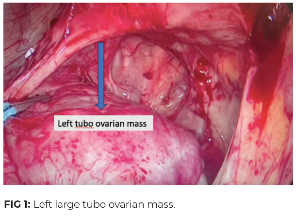 Left large tubo ovarian mass